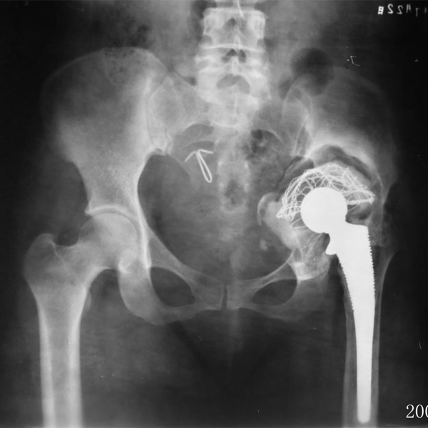 髖關節(jié)翻修